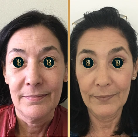 blefaroplastia1_1