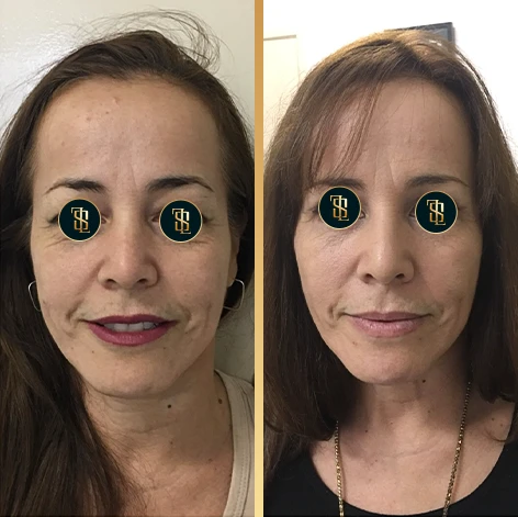 blefaroplastia1_2