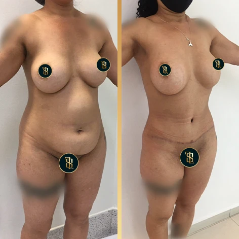 lipoabdominoplastia_1_2