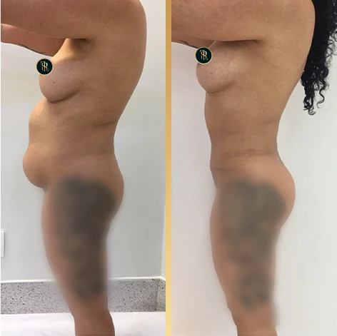 lipoabdominoplastia_1_3