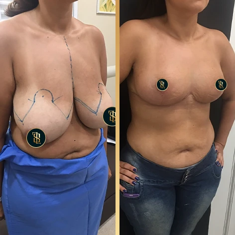 mamoplastia_redutora_1_2