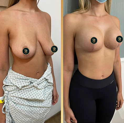 mastopexiacomsilicone_1_2