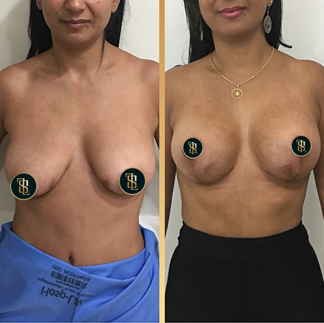 mastopexiacomsilicone_1_3