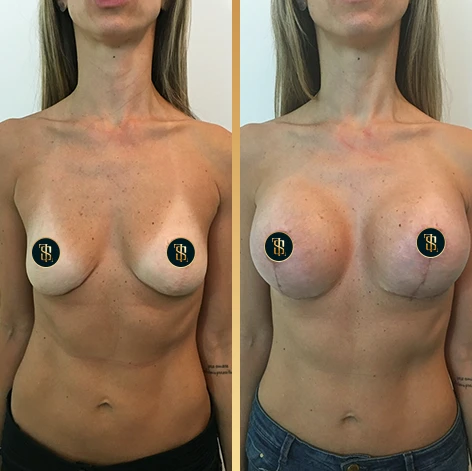 mastopexiacomsilicone_1_4