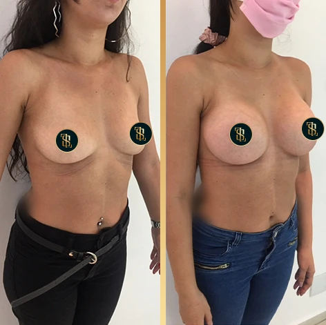 silicone_de_mama_1_2